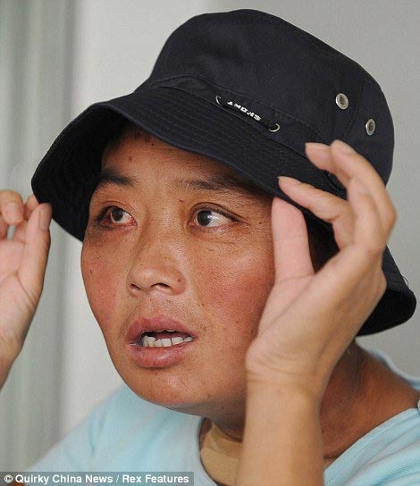 Chinese Woman with Disfigured Face