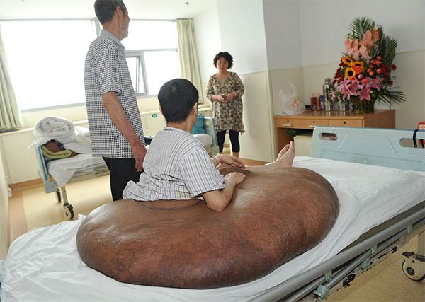 World’s Largest Tumor Removed From Man’s Back in China