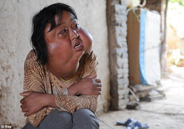 Chinese Woman with Disfigured Face