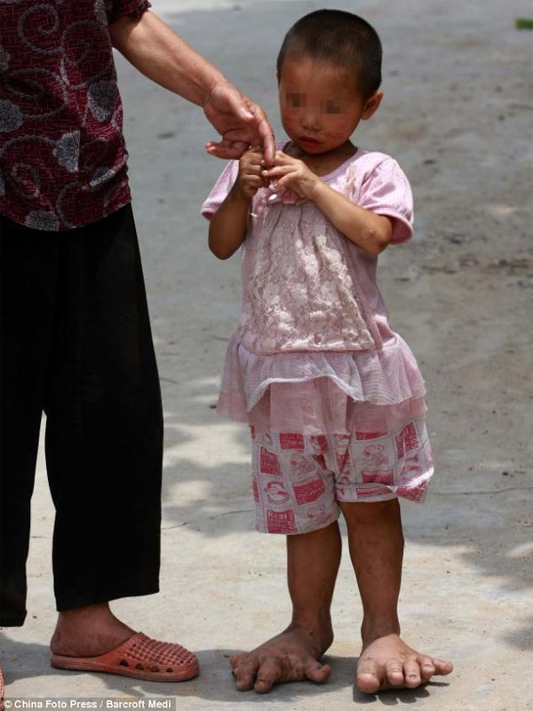 3-Yrs Old Girl With Monster Feet