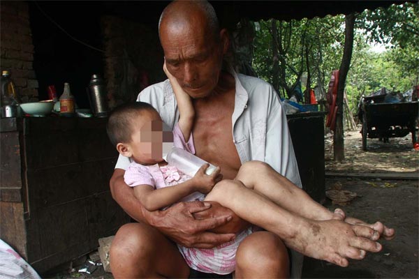 3-Yrs Old Girl With Monster Feet