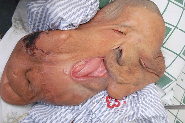 World's Biggest Facial Tumor