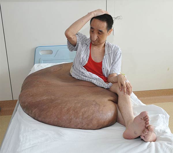 World's Largest Tumor