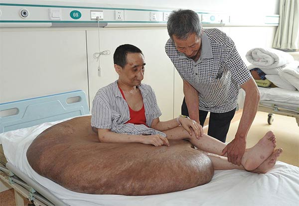 World's Largest Tumor