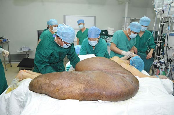 World's Largest Tumor