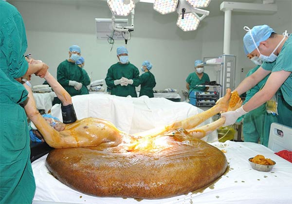 World's Largest Tumor