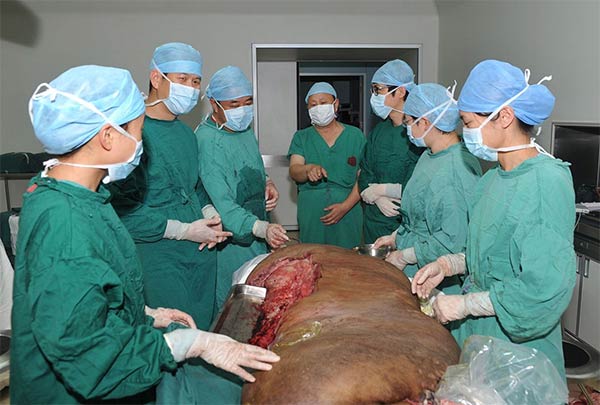 World's Largest Tumor